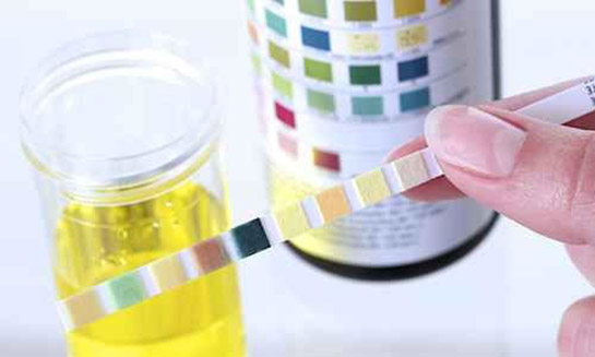 İdrarda Protein Çıkması Belirtileri ve Tedavisi