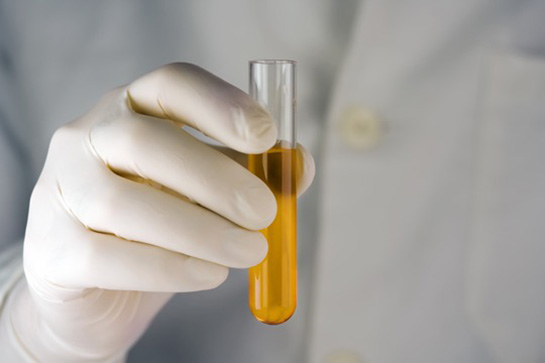 İdrarda Protein Yüksekliği Belirtileri ve Tedavisi